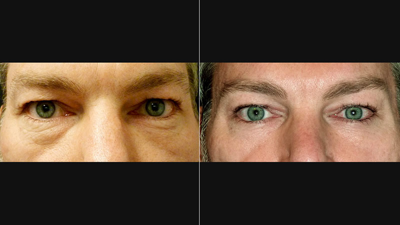 Före- & efterbild bild på ögonlockoperation utförd på manlig patient