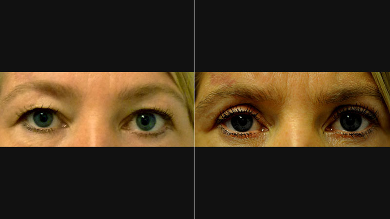 Före- & efterbilder på en kvinna som gjort ögonlocksoperation