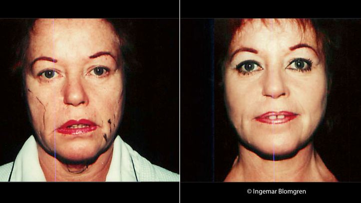 Före och efter bilder på kvinna som gjort ett ansiktslyft 