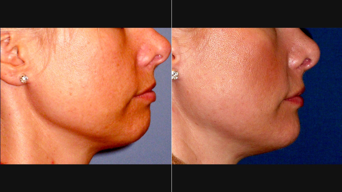 Före och efter bilder på kvinna som gjort hakimplantat 