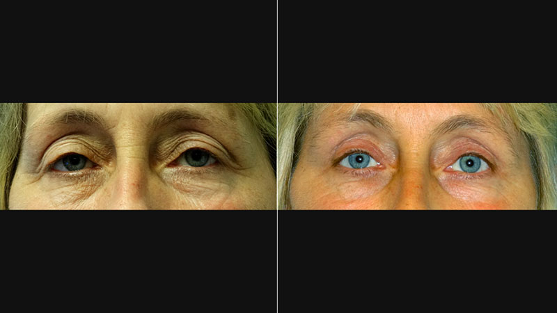 Före- & efterbild på ögonlocksplastik