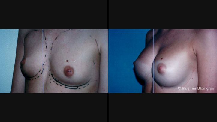 bröstoperation före och efter